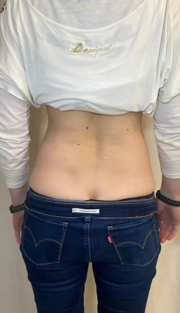 Preoblikovanje telesa z ultra shaper metodo - prej potem pas