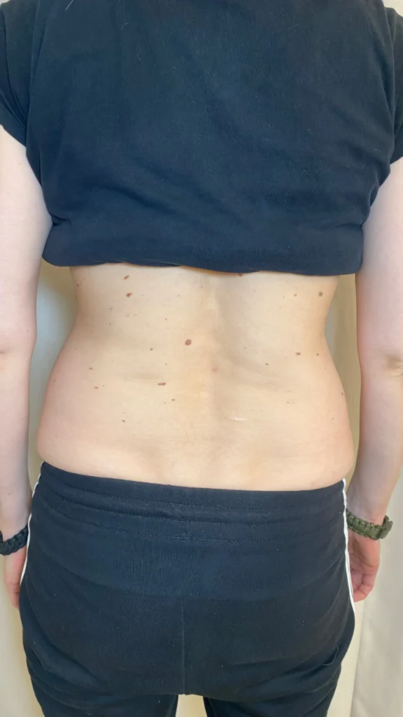 Preoblikovanje telesa z ultra shaper metodo - prej potem pas