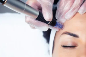 Microneedling vs. kemični piling - podrobna analiza za nego obraza